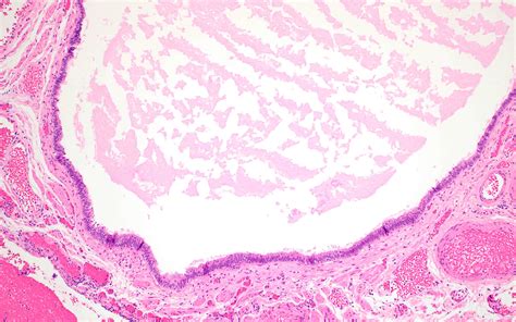 When a cyst ruptures from the ovary, there may be sudden and sharp pain in the lower abdomen on one side. . Fimbrial cyst pathology outlines